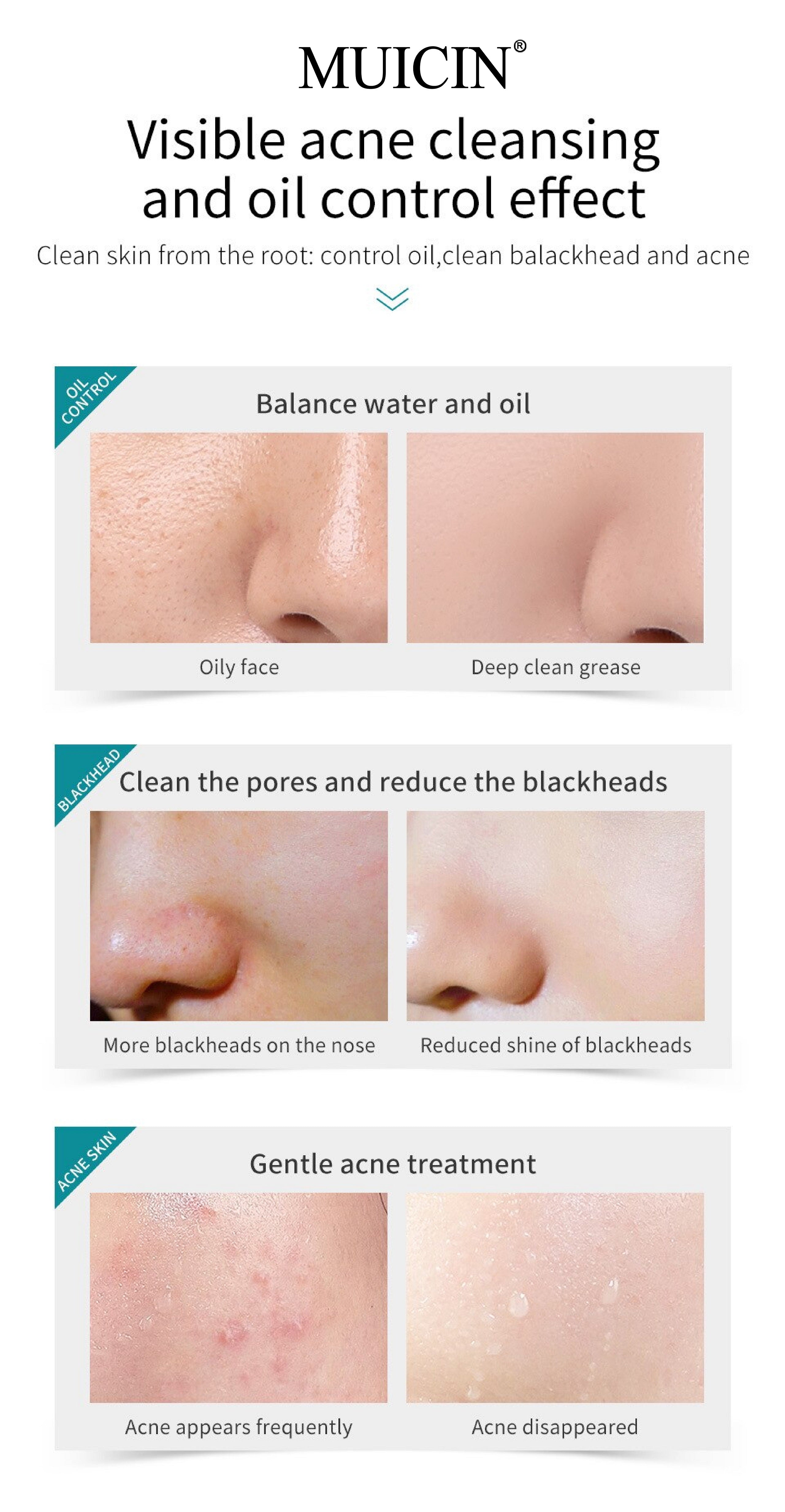 Buy MUICIN - Tea Tree Bubble Foaming Facial Cleanser - 150ml - at Best Price Online in Pakistan