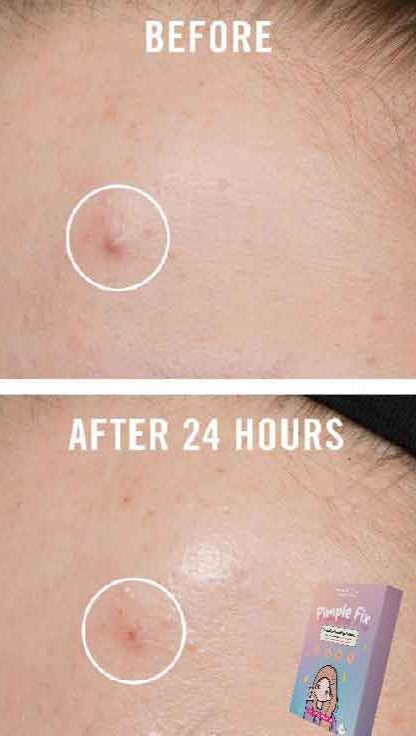Buy Nirvana Botanics Pimple Fix Overnight Healing Patches - 36 pcs - at Best Price Online in Pakistan