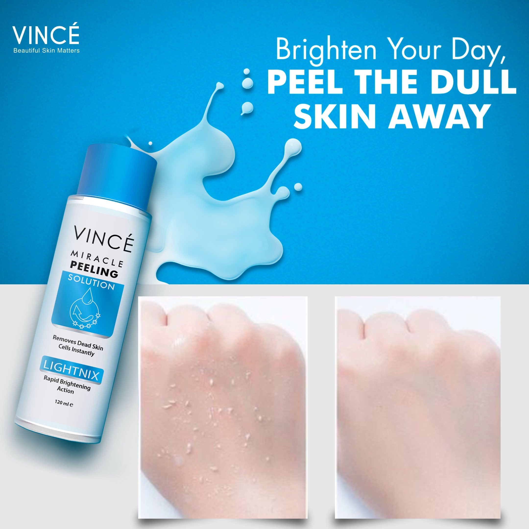 Buy Vince Miracle Peeling Solution - 120ml - at Best Price Online in Pakistan