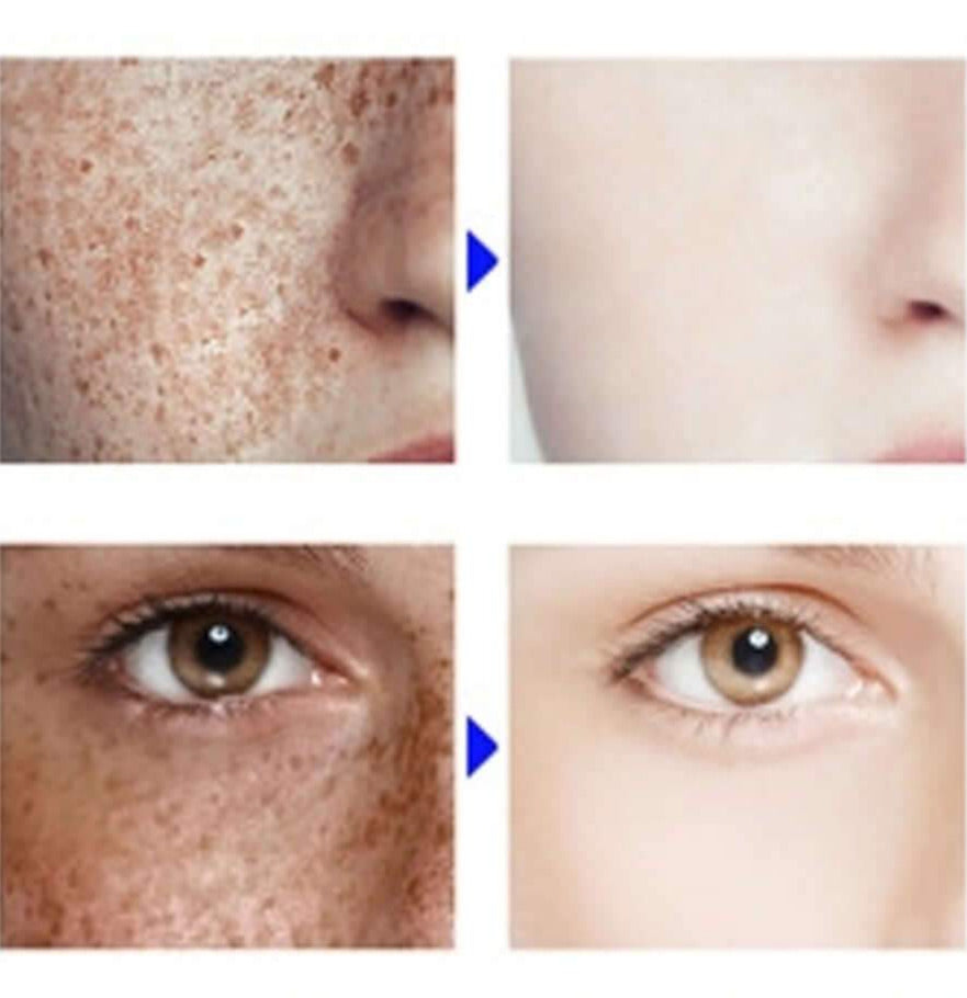 Buy Vince Freckle Challenge Kit - at Best Price Online in Pakistan