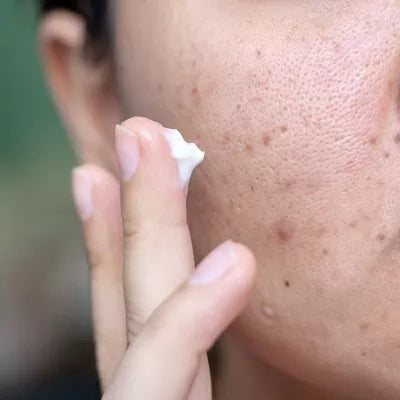 How to Get Rid of Black Spots: Skincare Tips and Solutions