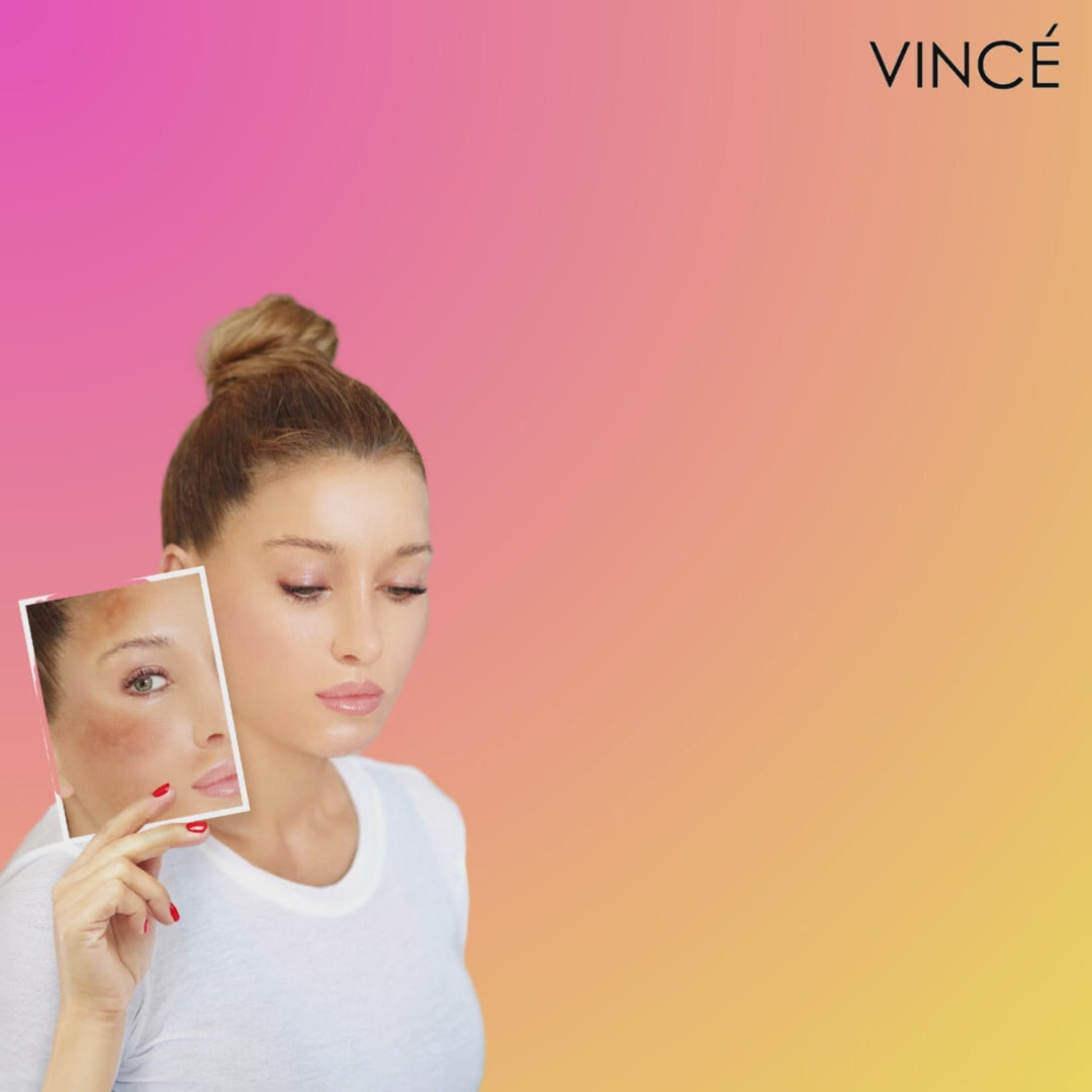 Buy  Vince Freckle Challenge Kit - at Best Price Online in Pakistan