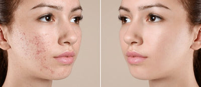 Buy  SL Basics Anti Acne Serum - 20ml - at Best Price Online in Pakistan